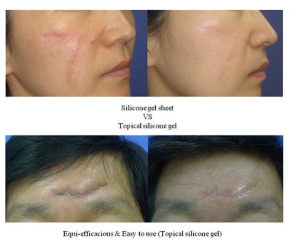 Dermatix Ultra Gel Silikon Yara Jeli 15 gr